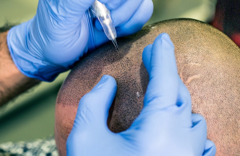 Scalp micropigmentation and pointillism - an origin story