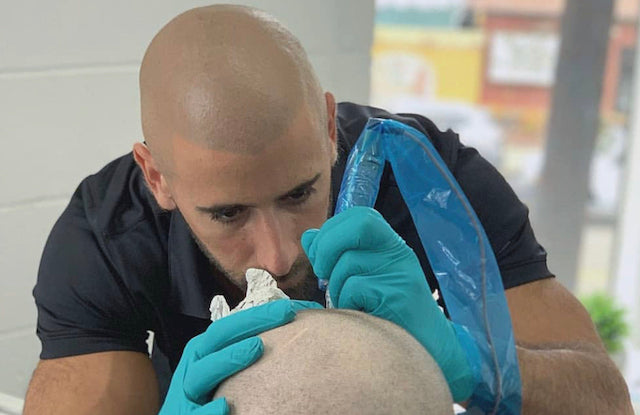 Scalp Micropigmentation vs Tattoos