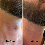 Scalp Wipes before and after on razor bumps